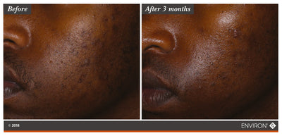The image displays a before-and-after comparison of skin, showing the left side labeled ’before’ with visible blemishes and the right side labeled ’after 3 months’ appearing clearer.