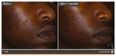 The image shows a before-and-after comparison of skin, with the ’after 3 months’ side displaying noticeably clearer and smoother skin than the ’before’ side.