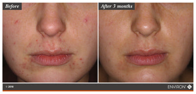 The image shows a before-and-after comparison of skin, with the ’after 3 months’ side displaying smoother and clearer skin than the initial state.