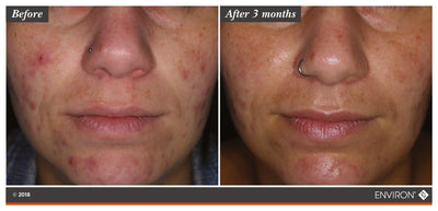 The image shows a before-and-after comparison of skin, with the ’after 3 months’ side displaying smoother and clearer skin than the ’before’ side.