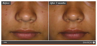 Smooth, skin-toned complexion with subtle glow and refined texture after three months of treatment.
