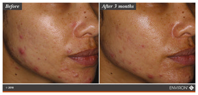 The image shows a before-and-after comparison of skin condition, with the right side labeled ’after 3 months’ and featuring improved clarity.