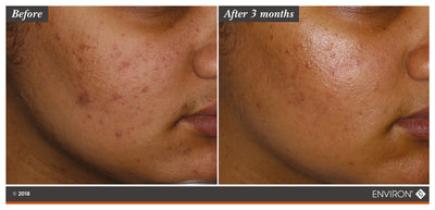 The image shows a before-and-after comparison of skin, with the ’after 3 months’ side displaying noticeably clearer and smoother skin than the initial condition.