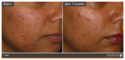 The image shows a before-and-after comparison of skin texture and acne, with the ’after 3 months’ side displaying visibly smoother and clearer skin than the initial state.