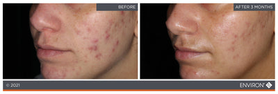 The image shows a before-and-after comparison of skin, with the ’after’ side displaying significantly clearer and smoother skin than the ’before’ side.