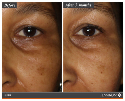 The image shows a before-and-after comparison of skin under the eye area, highlighting reduced dark circles and smoother texture after three months.