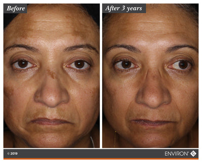 The image displays a before-and-after comparison of a woman’s face, showing the results of an environ skincare treatment after three years.