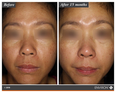 The image displays a before-and-after comparison of facial skin, with the ’after 15 months’ side showing visibly smoother and more even-toned skin than the original.