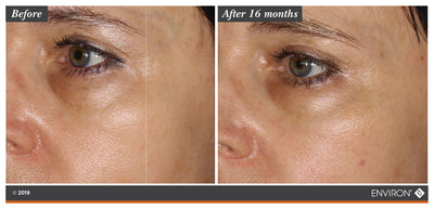 The image shows a before-and-after comparison of skin under the eye, with no main object to describe.