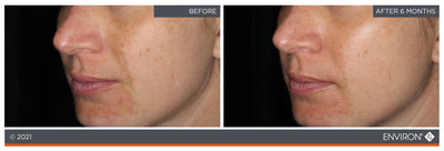 The image displays a before-and-after comparison of skin tone and texture, showcasing the results from an environ skincare treatment.