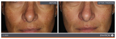 Environ skincare treatment results showing improved skin texture and tone after seven months.