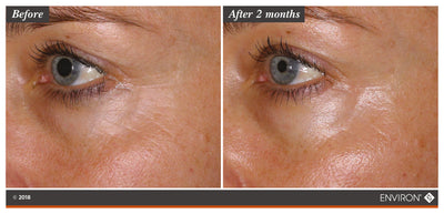 The image shows a before-and-after comparison of an eye area, with the ’after 2 months’ side displaying smoother skin and reduced fine lines.