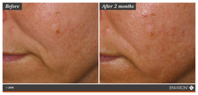 The image shows a before-and-after comparison of skin texture and tone, highlighting the results after two months.