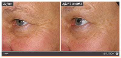 The image shows a before-and-after comparison of an eye area, with the ’after 3 months’ side displaying visibly smoother skin and reduced wrinkles compared to the ’before’ side.