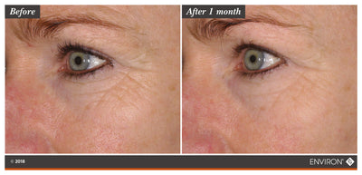 The image shows a before-and-after comparison of an eye area, with the ’after 1 month’ side displaying visibly smoother skin and reduced wrinkles.
