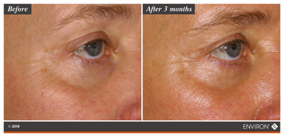 The image shows a before-and-after comparison of an eye area, with the ’after 3 months’ side displaying smoother skin and reduced fine lines compared to the ’before’ side.