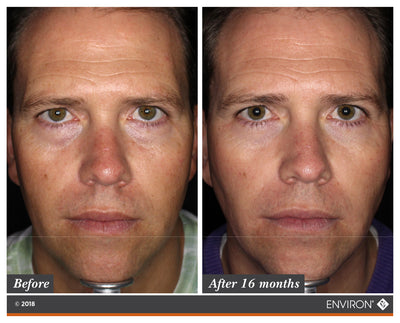 The image shows a before-and-after comparison of a man’s face, highlighting the results of an environ skincare treatment after 16 months.