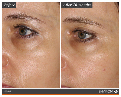 The image shows a before-and-after comparison of an eye area, with the ’after 16 months’ side displaying visibly smoother and more even skin tone.