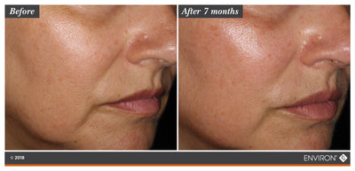 The image displays a before-and-after comparison of skin texture and tone, with the ’after 7 months’ side showing smoother, more even-toned skin.