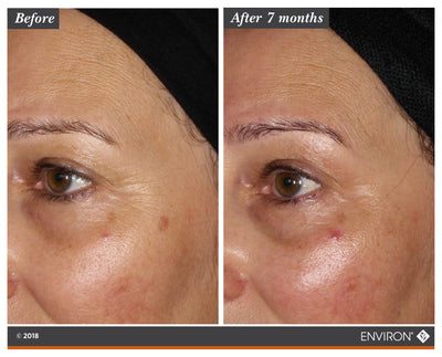 The image shows a before-and-after comparison of skin around the eye area, highlighting improvements after seven months.
