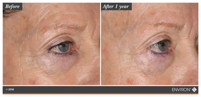 The image shows a before-and-after comparison of an eye area, with the ’after 1 year’ side displaying visibly smoother skin and reduced wrinkles compared to the ’before’ side.