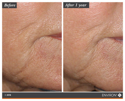 The image shows a before-and-after comparison of skin texture, with the ’after 1 year’ side displaying smoother and more even-toned skin than the wrinkled ’before’ side.