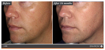 The image shows a before-and-after comparison of skin texture and tone, with the ’after 16 months’ side displaying visibly smoother and more even-toned skin than the initial state.