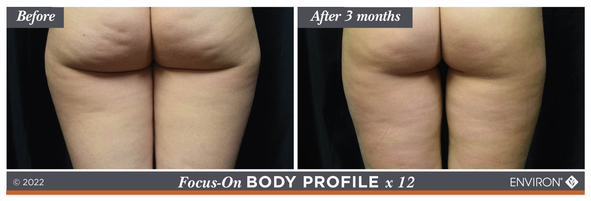 The image displays a before-and-after comparison of buttocks, with the ’after 3 months’ side showing visibly smoother and more toned skin than the initial state.