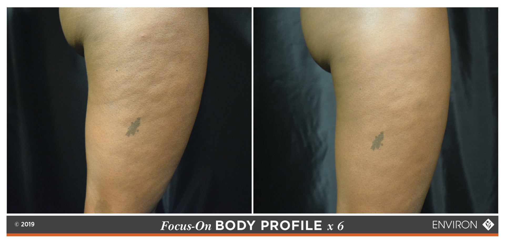 The image displays a before-and-after comparison of skin texture on a leg, with the left side showing visible venous patterns and the right side appearing smoother.