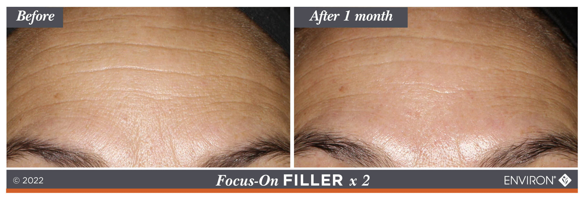 The image displays a before-and-after comparison of forehead skin texture, showing smoother and less pronounced wrinkles after one month of treatment with environ’s focus-on filler x 2.