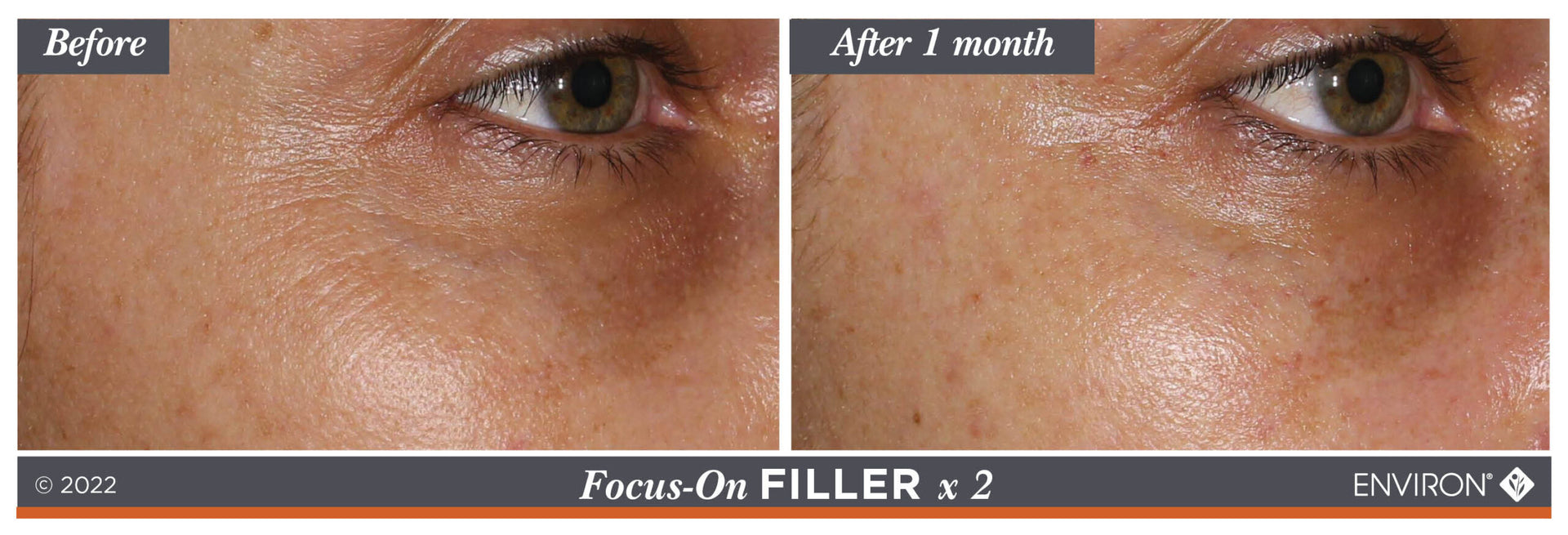 The image displays a before-and-after comparison of an eye area treated with environ’s focus-on filler x 2, showing improved skin texture and reduced fine lines.