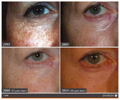 A close-up of a woman’s eye showing skin texture and color changes over time, with visible age spots in 1995 and more pronounced redness around the eyelid by 2014.
