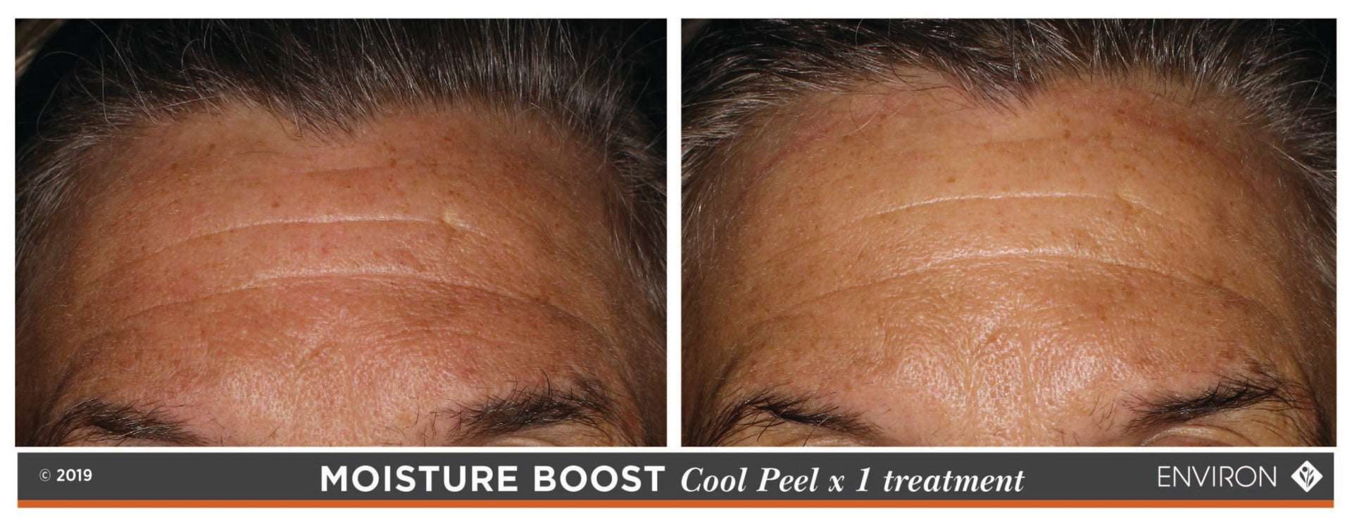 The image displays a before-and-after comparison of skin texture and appearance following an environ moisture boost cool peel x1 treatment.