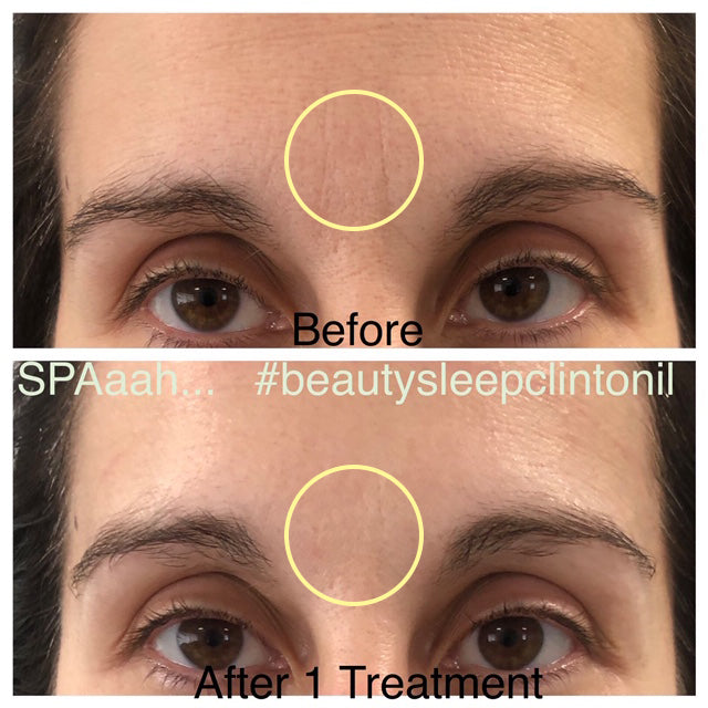 The image shows a before-and-after comparison of skin texture around the eyes, highlighting smoother and more even-toned results after one treatment.