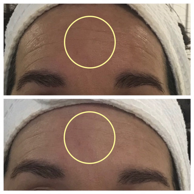 The image shows a close-up of a person’s forehead with visible skin texture and fine lines, framed by dark eyebrows and partially covered by a white towel.