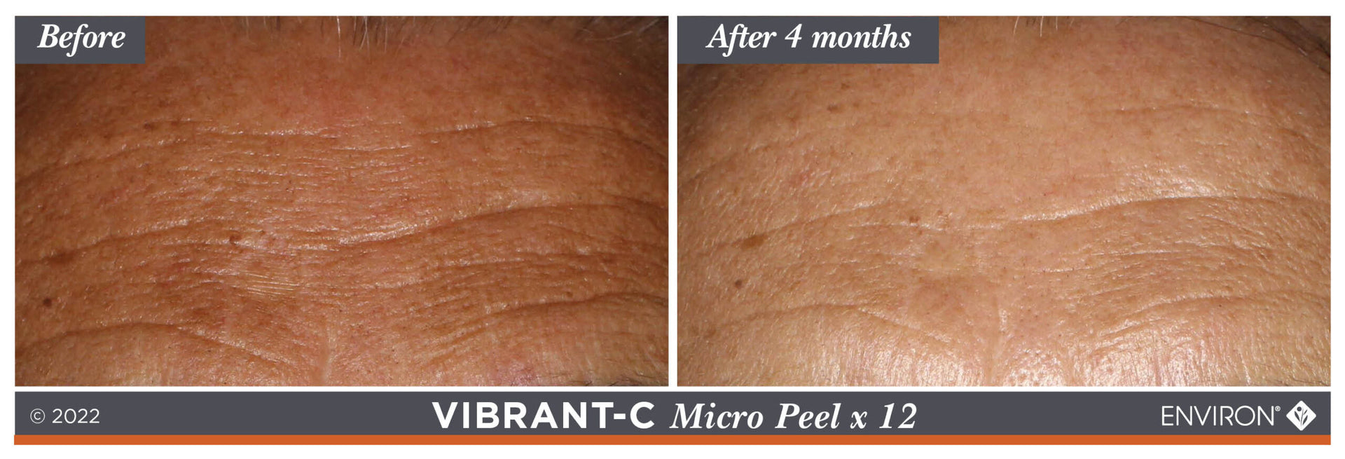 The image displays a before-and-after comparison of skin texture, showcasing the results of an environ vibrant-c micro peel x 12 treatment.