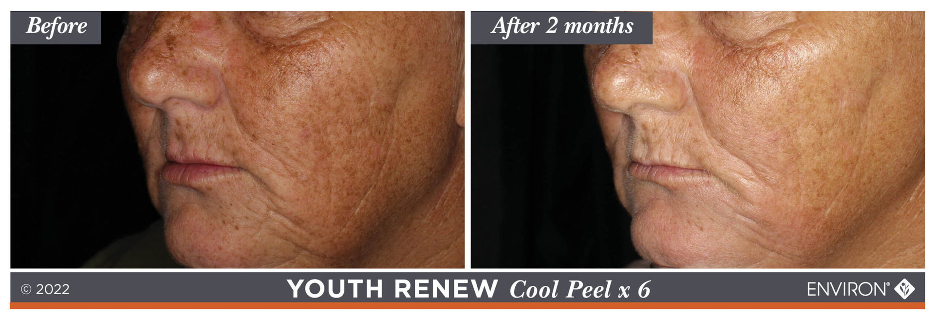 The image displays a before-and-after comparison of skin treatment results for the youth renew cool peel x 6 by enviro.