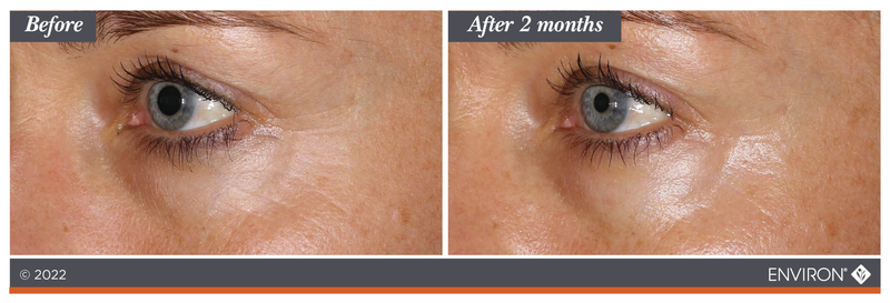 The image shows a before-and-after comparison of an eye area, with the ’after 2 months’ side displaying smoother skin and reduced fine lines.