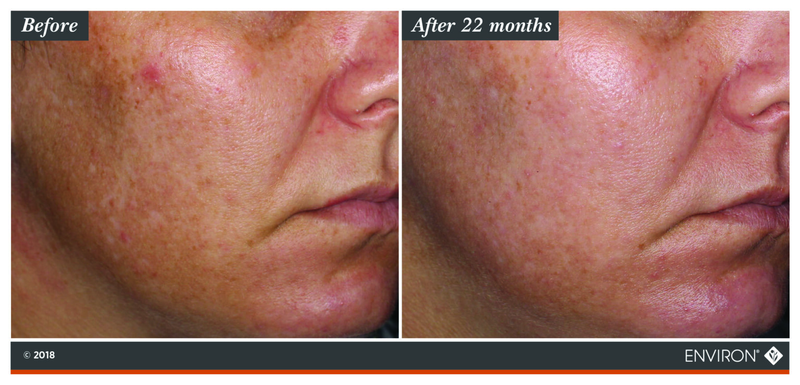 The image shows a before-and-after comparison of skin texture and tone, with the ’after 22 months’ side displaying visibly smoother and more even-toned skin than the ’before’ side.