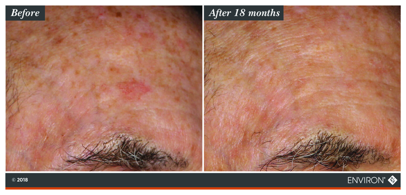 The image shows a before-and-after comparison of skin condition, with the ’after 18 months’ side displaying visibly improved clarity and reduced redness compared to the initial state.
