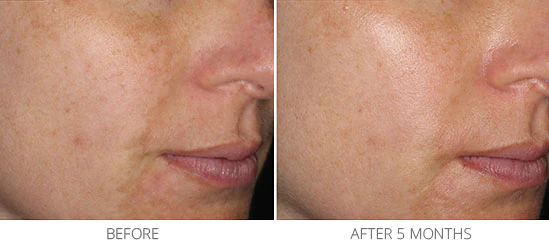 The image shows a before-and-after comparison of skin tone, highlighting the reduction in dark spots and uneven pigmentation after five months.