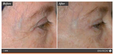 The ’before’ and ’after’ comparison image showcases the results of environ’s skincare treatment on a person’s eye area, highlighting improved skin texture and reduced fine lines.