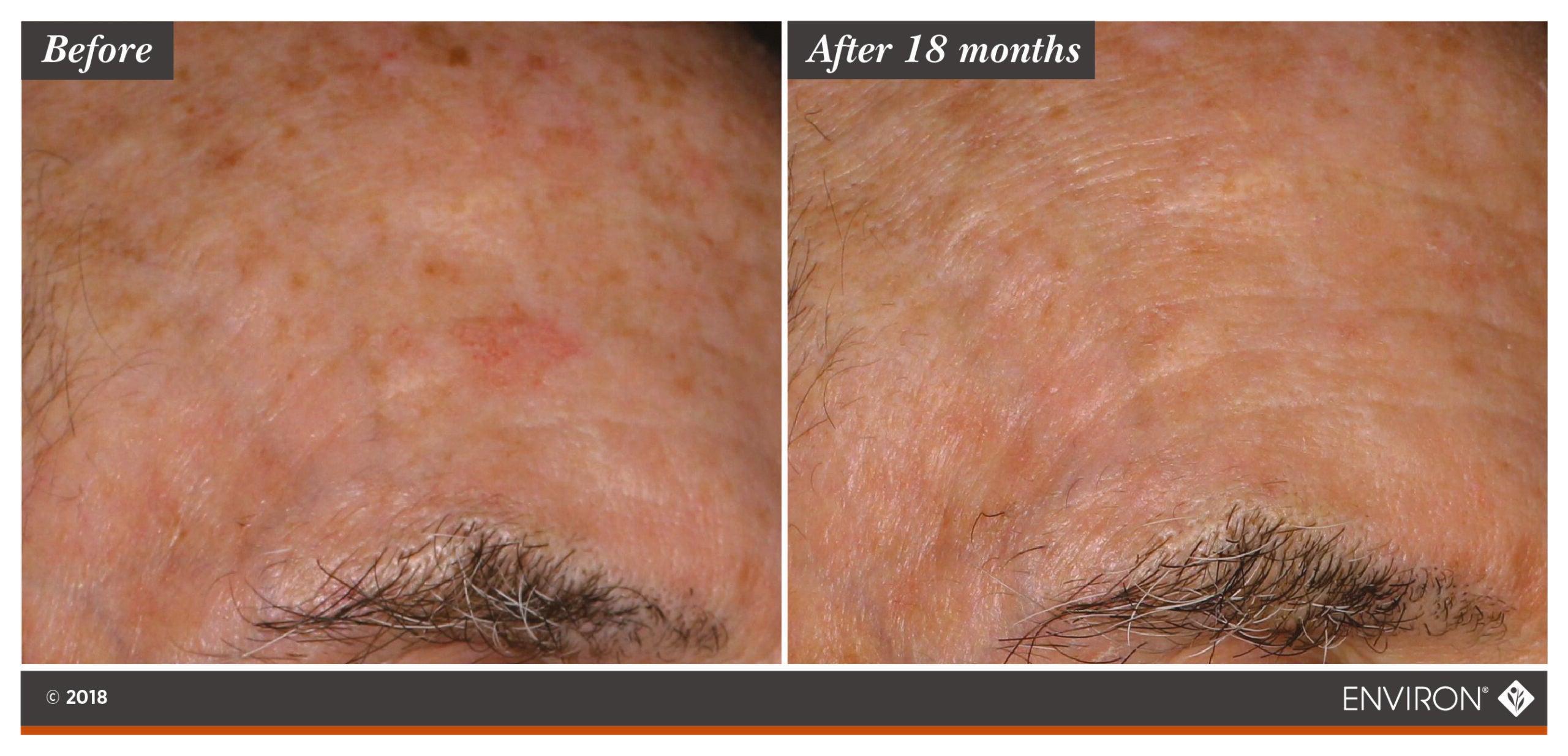The image displays a before-and-after comparison of skin texture and tone, with the ’after 18 months’ side showing visibly smoother and more even-toned skin compared to the rougher, patchier appearance in the ’before’ panel.
