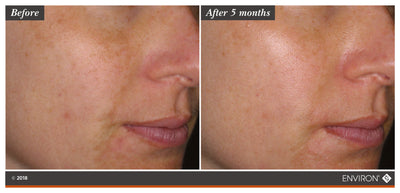 The image displays a before-and-after comparison of skin tone, with the ’after 5 months’ side showing noticeably lighter and more even-toned skin compared to the original.