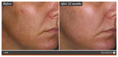 The image shows a before-and-after comparison of skin texture and tone, with the ’after 22 months’ side displaying visibly smoother and more even-toned skin than the initial state.