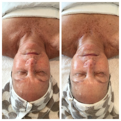 A person’s face, showing a before-and-after comparison of skin texture and tone with visible freckles in the left image and smoother, more even-toned skin in the right.