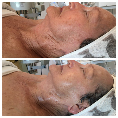 A woman’s face and neck, showing skin with visible age spots and wrinkles before and after a treatment.