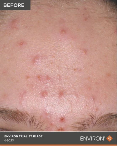 Skin with visible acne lesions and redness.