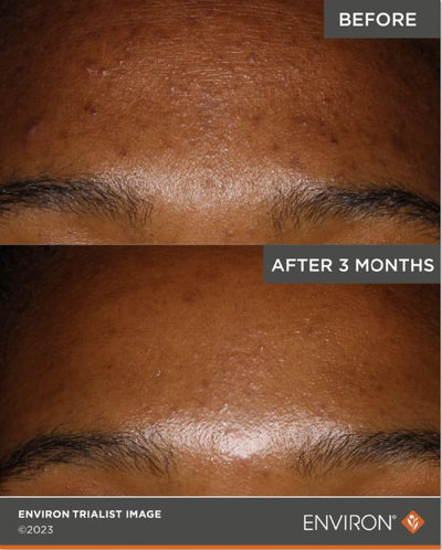 The image shows a before-and-after comparison of skin texture and tone, with the ’after’ section displaying smoother, more even-toned skin.