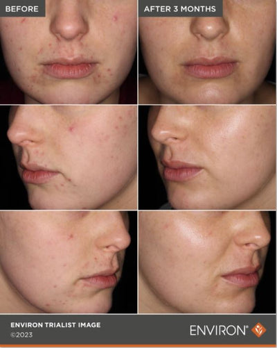 A close-up of a person’s face showing skin before and after treatment, with the ’before’ images displaying visible acne and blemishes while the ’after 3 months’ images show significantly clearer, smoother skin.